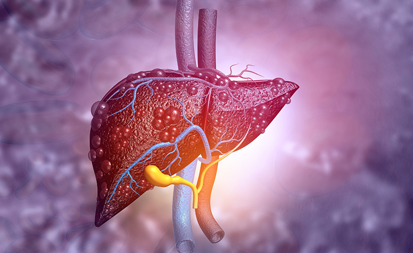 Colonic Liver Disease Image