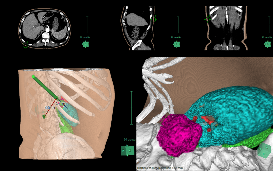 Endoscopic 3D Modeling Image Solutions Fujifilm Healthcare