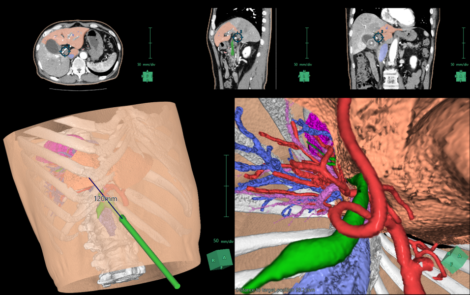 Endoscopic 3D Modeling Image Solutions Fujifilm Healthcare