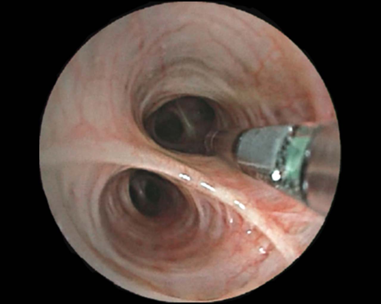 Fujifilm ultrasonic radial probe being inserted into the bronchi.