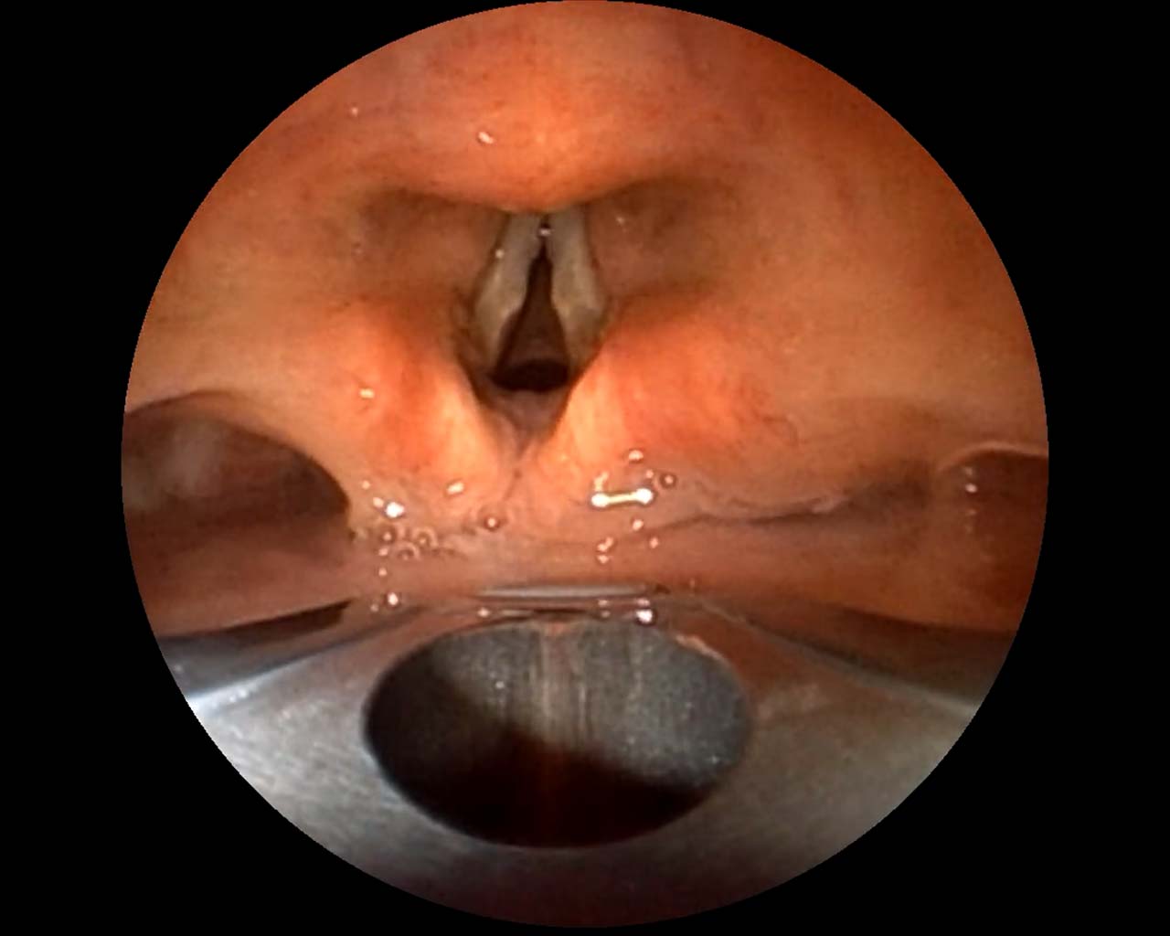 Fujifilm EB-710US endobronchial ultrasound (EBUS) scope entering the trachea.