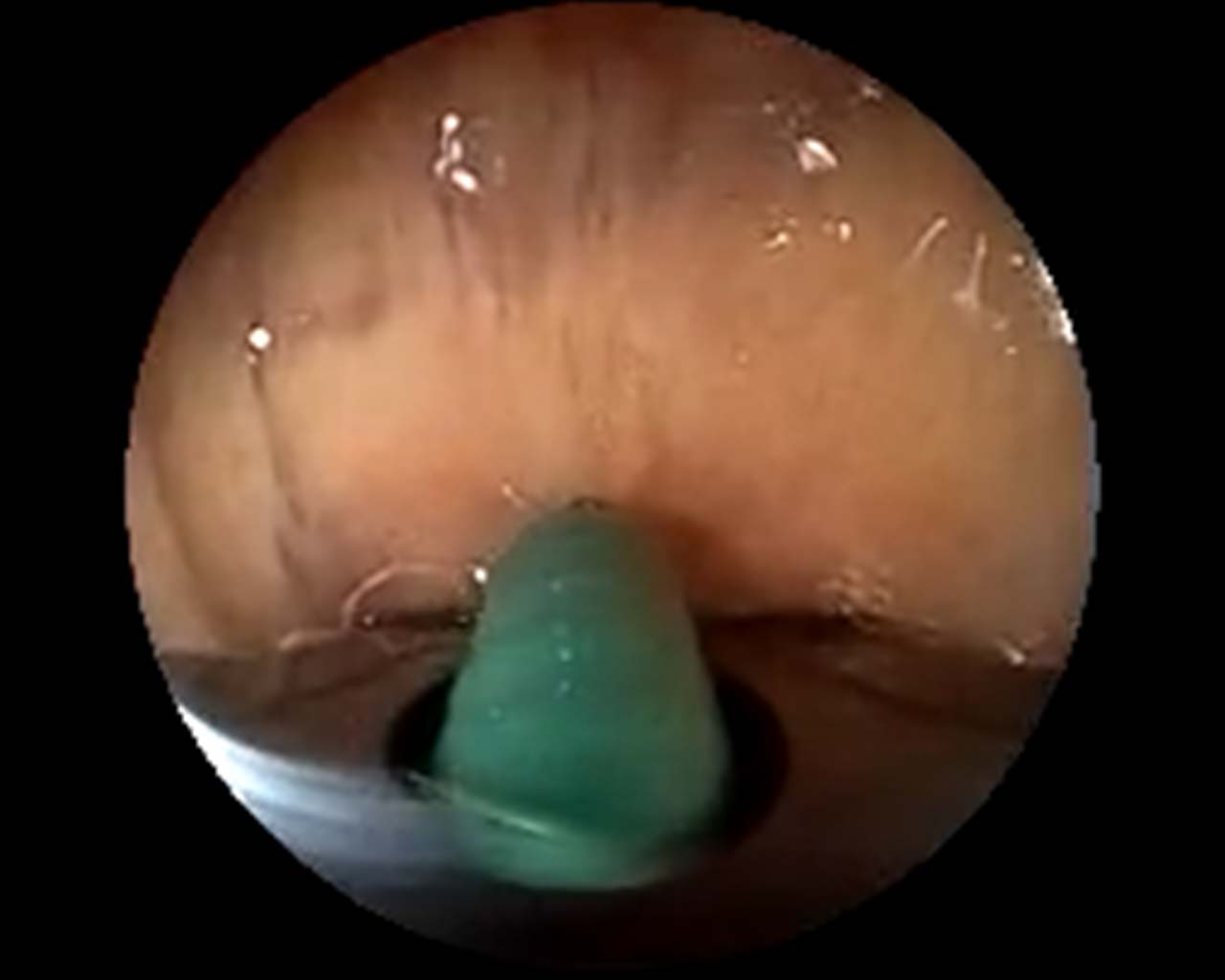 Needle exiting the working channel of the Fujifilm EB-710US endobronchial ultrasound (EBUS) scope.