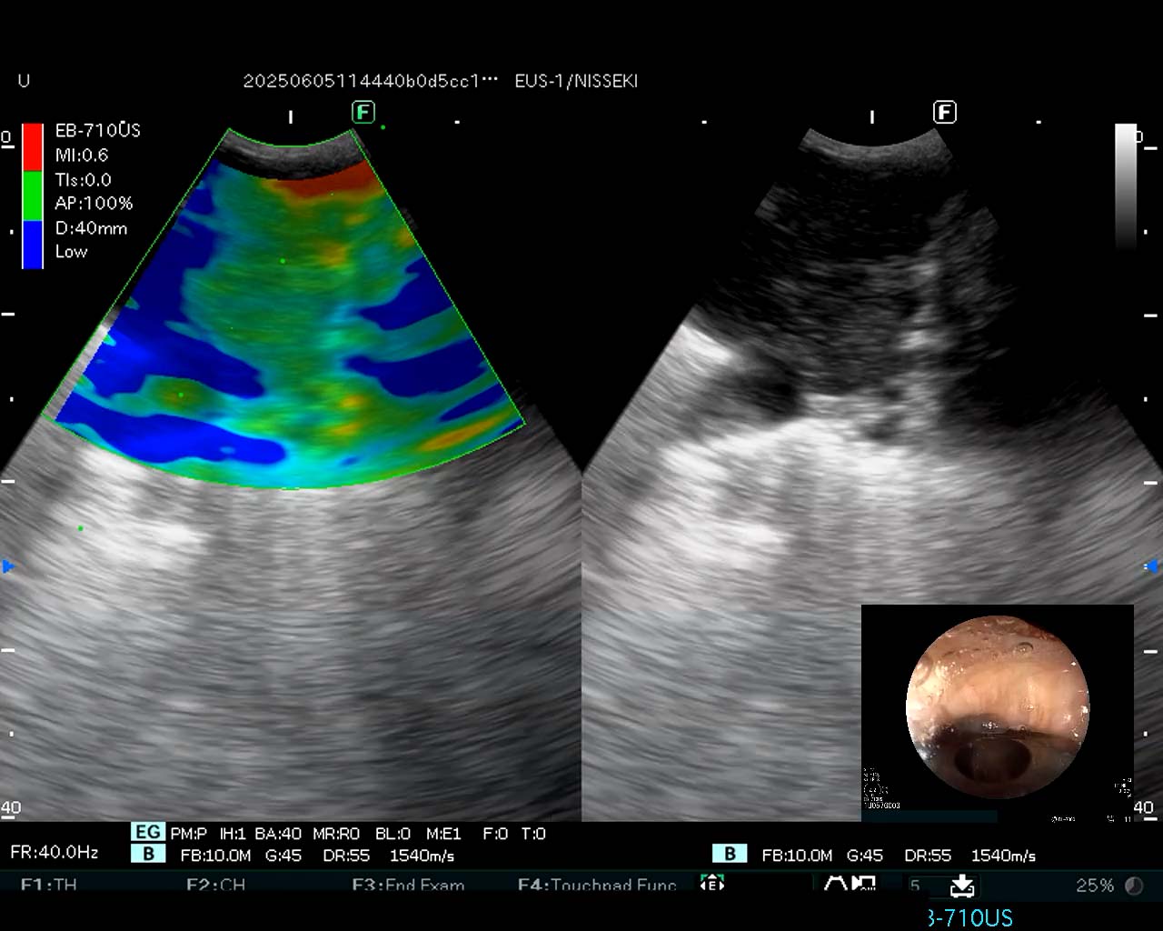 Ultrasound image and endoscopic view with Fujifilm EB-710US endobronchial ultrasound (EBUS) scope.